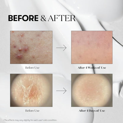 VT COSMETICS Mild Reedle Shot 50 | Microneedling en suero