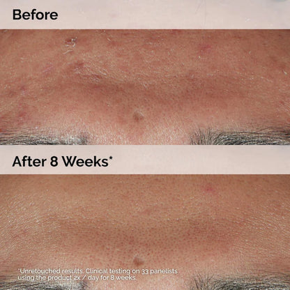 The Ordinary Niacinamide 10% + Zinc 1% Oil Control Serum