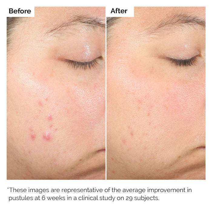 The Ordinary Salicylic Acid 2% Exfoliating Blemish Solution